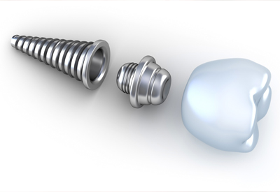 Dental Implant Placement | Blue Ridge, GA | Franklin, NC