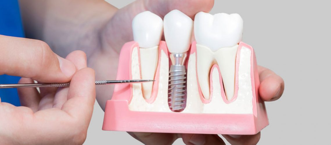 Dental Assistant Showing Off A Dental Implant In A Jawbone Cutaway Model in Blue Ridge, GA