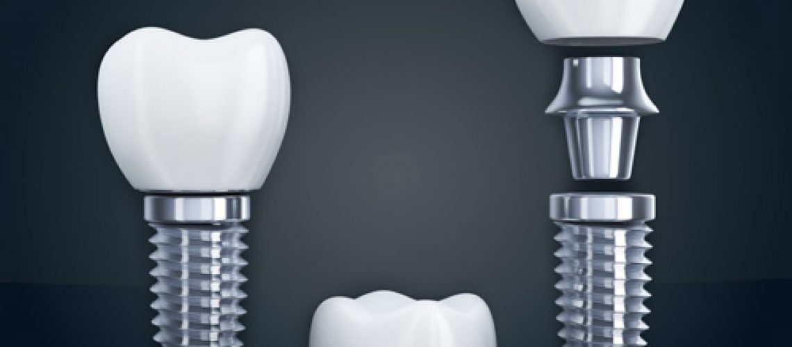 the three different parts which make up a dental implant