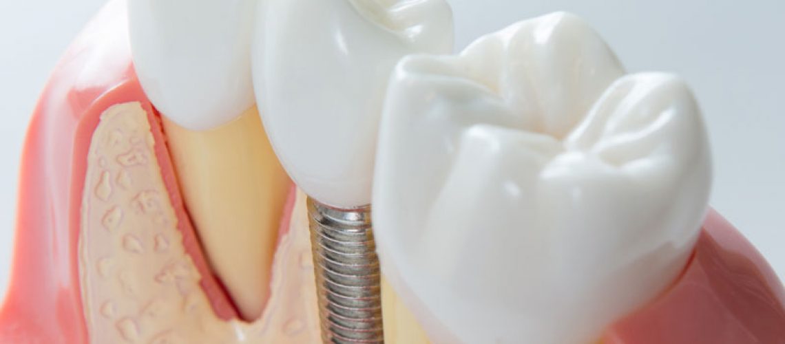 a digital model of a dental implant post and crown.