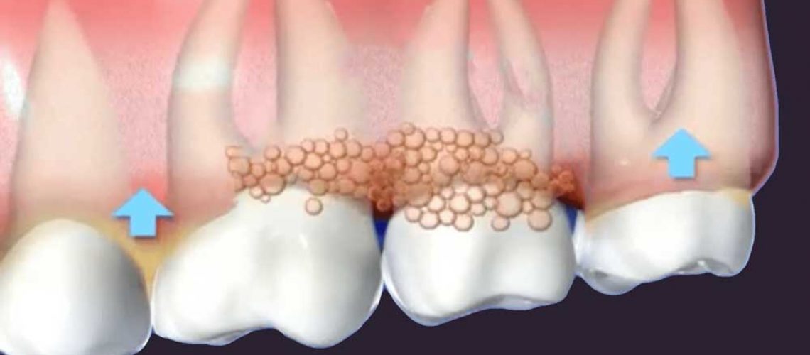 a diagram depicting gums affected by gum disease
